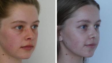 Top Sydney Rhinoplasty Surgeons: Transforming Facial Aesthetics with Expertise