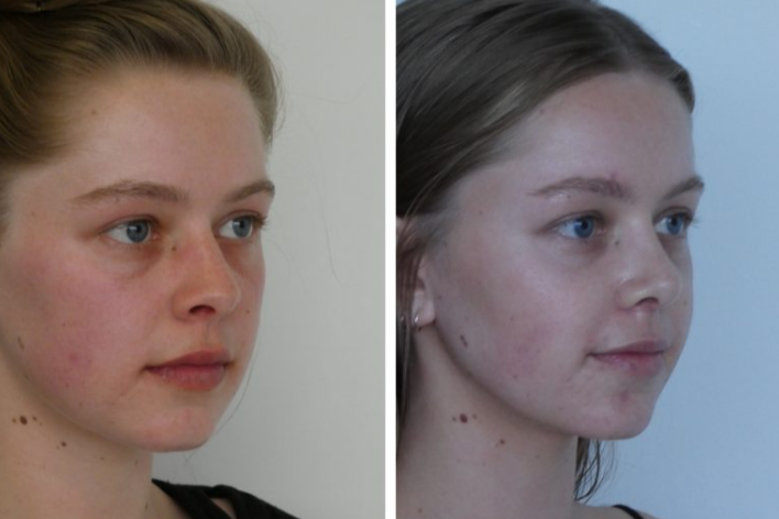 Top Sydney Rhinoplasty Surgeons: Transforming Facial Aesthetics with Expertise