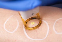 Effective Spider Vein Removal: How Evolution Laser Clinic Helps You Achieve Clearer Skin