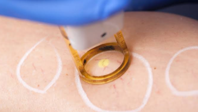 Effective Spider Vein Removal: How Evolution Laser Clinic Helps You Achieve Clearer Skin
