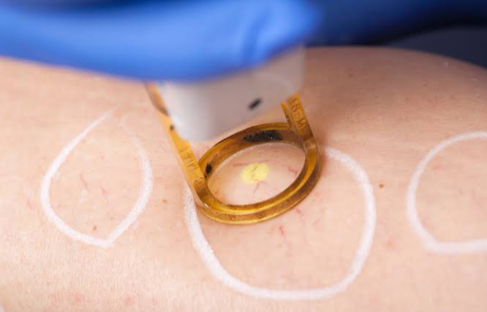 Effective Spider Vein Removal: How Evolution Laser Clinic Helps You Achieve Clearer Skin