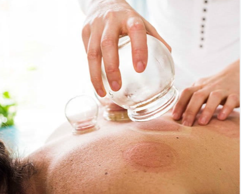 Exploring the Benefits and Training of Hijama Therapy