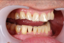 Why Surface Roughness Can Make Dental Bonding Look Older Than It Is