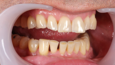 Why Surface Roughness Can Make Dental Bonding Look Older Than It Is