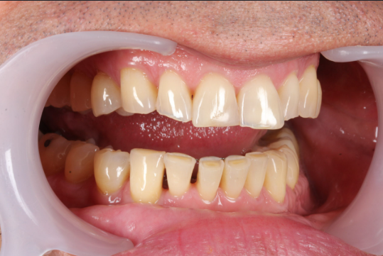 Why Surface Roughness Can Make Dental Bonding Look Older Than It Is