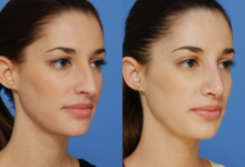 Understanding Dr Shahidi Rhinoplasty Surgery