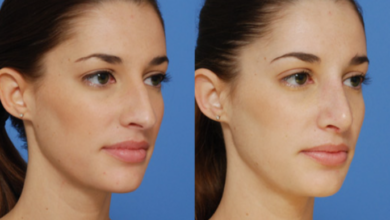 Understanding Dr Shahidi Rhinoplasty Surgery