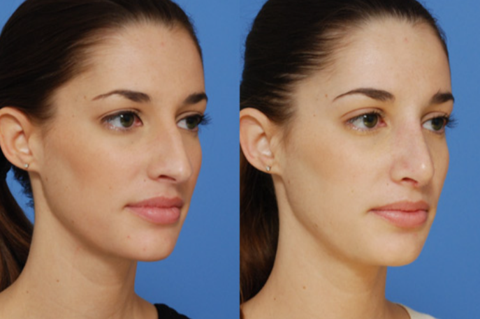 Understanding Dr Shahidi Rhinoplasty Surgery