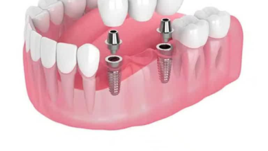 Bridge Dental Implants: The Modern Solution for a Complete Smile