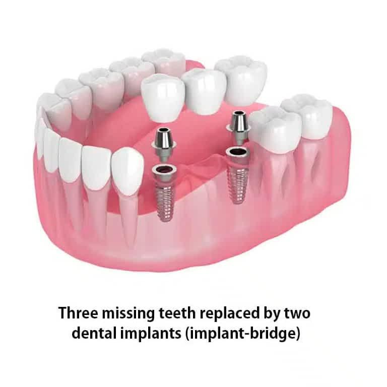 Bridge Dental Implants: The Modern Solution for a Complete Smile