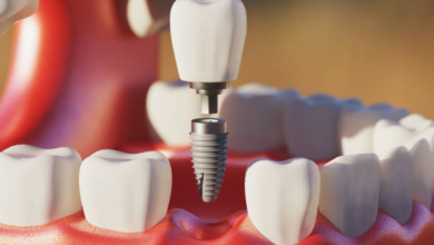 Quality Permanent Dental Implants for Long-Term Tooth Replacement