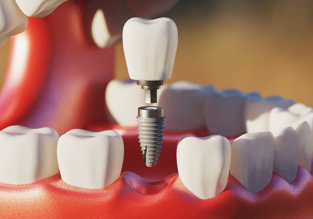 Quality Permanent Dental Implants for Long-Term Tooth Replacement